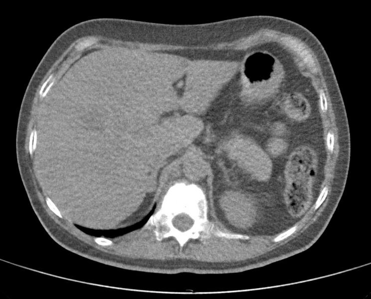 File:Adenosquamous lung carcinoma (Radiopaedia 22035-22030 non-contrast 58).jpg