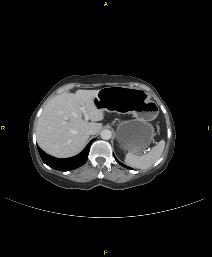 Adhesional small bowel obstruction (Radiopaedia 85402-101024 Axial C+ portal venous phase 61).jpg