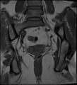 Adnexal multilocular cyst (O-RADS US 3- O-RADS MRI 3) (Radiopaedia 87426-103754 Coronal 22).jpg