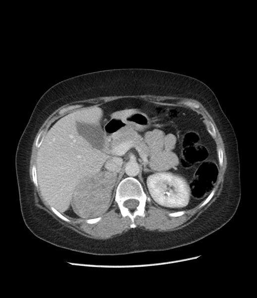 File:Adrenal cortical carcinoma with IVC invasion and thrombosis (Radiopaedia 34307-35597 Axial C+ portal venous phase 27).jpg