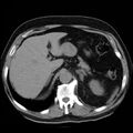 Adrenal hemangioma (Radiopaedia 11039-11445 Axial non-contrast 3).jpg