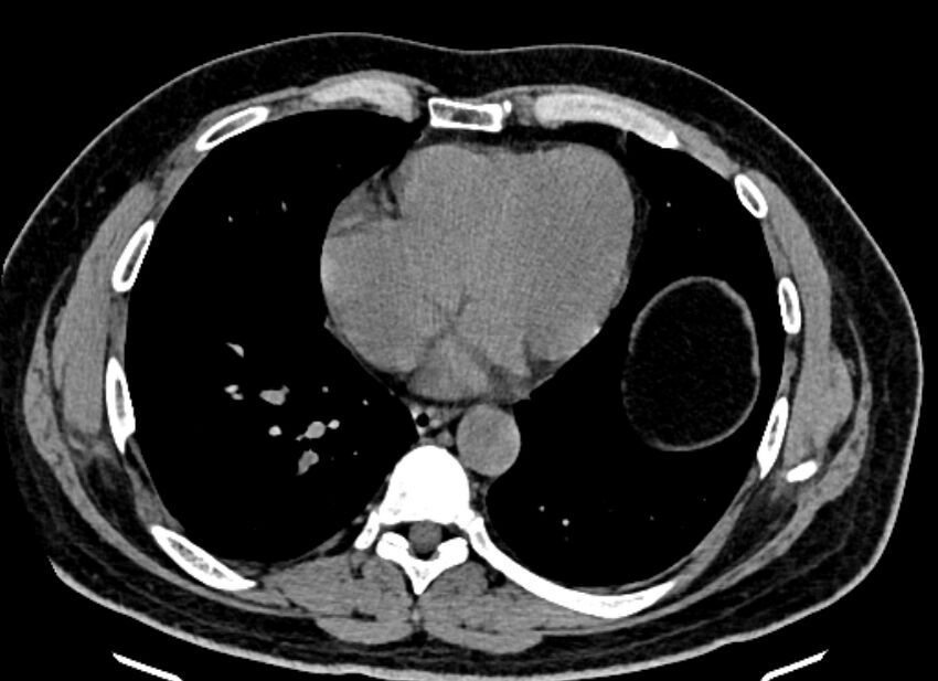 Adrenal metastases (Radiopaedia 73082-83791 Axial non-contrast 1).jpg