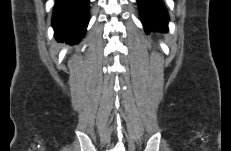 File:Adrenal myelolipoma (Radiopaedia 65240-74253 Coronal non-contrast 66).jpg