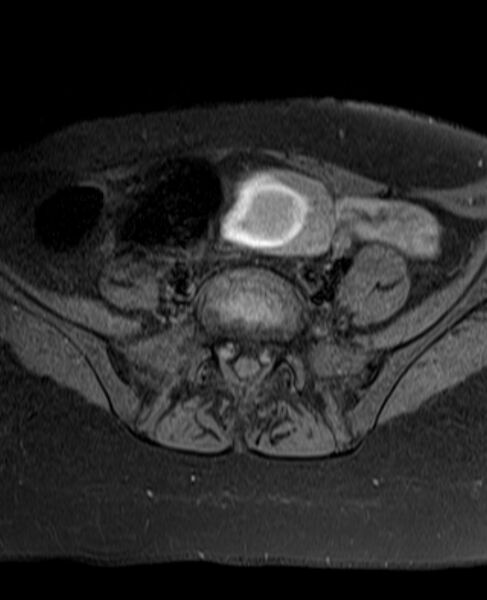 File:Adult granulosa cell tumor of the ovary (Radiopaedia 71581-81950 Axial T1 fat sat 6).jpg