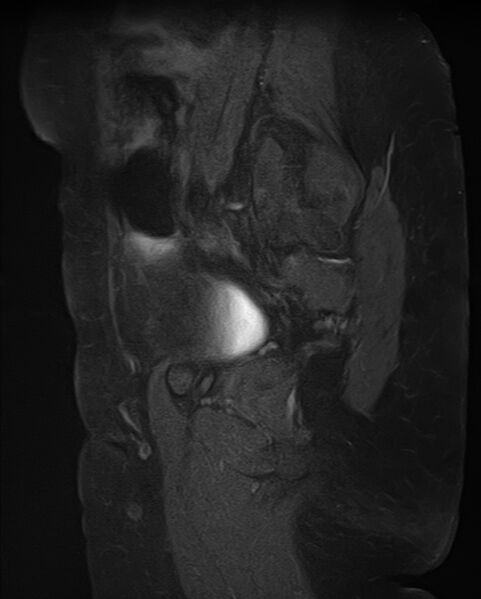 File:Adult granulosa cell tumor of the ovary (Radiopaedia 71581-81950 Sagittal T1 C+ fat sat 5).jpg