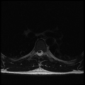 Aggressive vertebral hemangioma (Radiopaedia 39937-42404 Axial T2 26).png