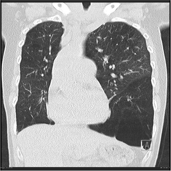 File:Alpha-1-antitrypsin deficiency (Radiopaedia 26537-26678 Coronal lung window 11).jpg