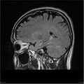 Amnestic syndrome secondary to hypoxic brain injury (Radiopaedia 24743-25004 D 17).jpg