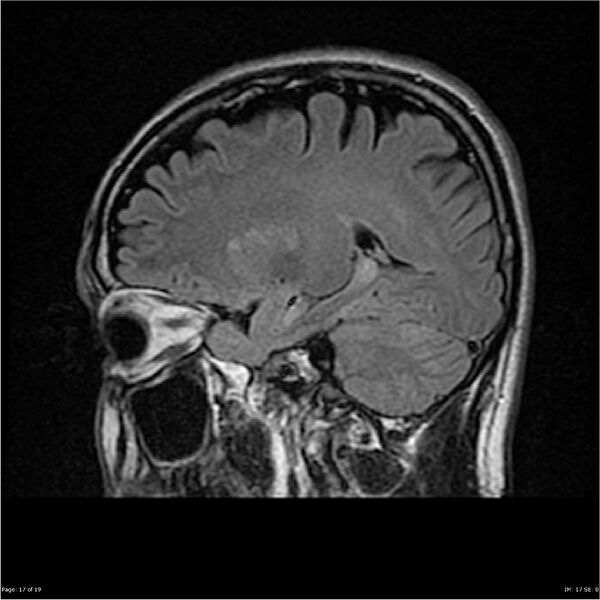 File:Amnestic syndrome secondary to hypoxic brain injury (Radiopaedia 24743-25004 D 17).jpg