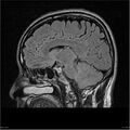 Amnestic syndrome secondary to hypoxic brain injury (Radiopaedia 24743-25004 D 6).jpg