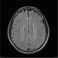 Amnestic syndrome secondary to hypoxic brain injury (Radiopaedia 24743-25004 FLAIR 14).jpg