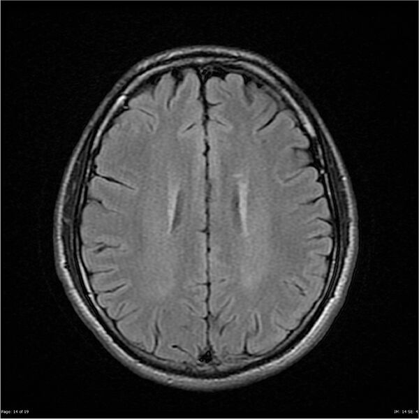 File:Amnestic syndrome secondary to hypoxic brain injury (Radiopaedia 24743-25004 FLAIR 14).jpg