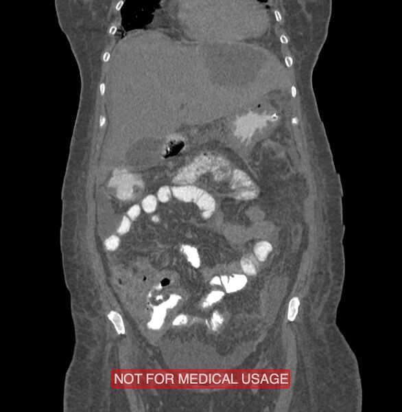 File:Amoebic enterocolitis with liver abscess (Radiopaedia 35100-36609 B 51).jpg