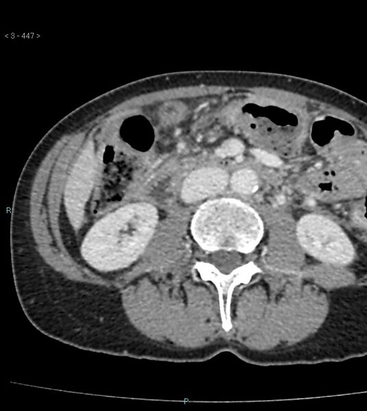 File:Ampulla of Vater metastasis (Radiopaedia 27820-28065 A 51).jpg