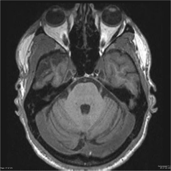 File:Anaplastic meningioma with recurrence (Radiopaedia 34452-35788 Axial T1 35).jpg
