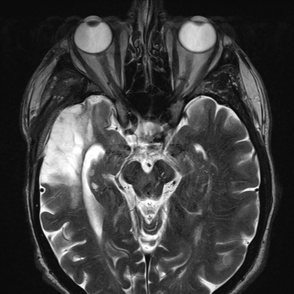 File:Anaplastic meningioma with recurrence (Radiopaedia 34452-35788 Axial T2 7).png
