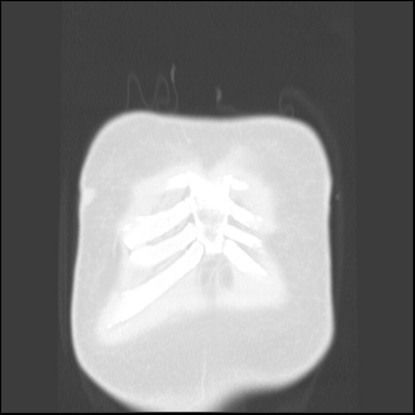 Angioinvasive aspergillosis (Radiopaedia 43957-47466 Coronal lung window 90).jpg