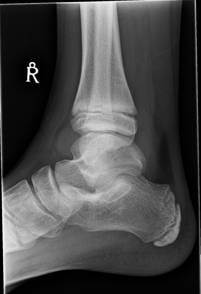 File:Ankle joint effusion post-trauma (Radiopaedia 44180-47766 Lateral 1).jpg
