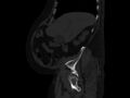 Ankylosing spondylitis (Radiopaedia 44609-48357 Sagittal bone window 16).jpg