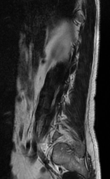 File:Ankylosing spondylitis - Andersson lesion (Radiopaedia 81878-95838 Sagittal T2 2).jpg