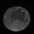Anterior cruciate ligament tear, Wrisberg rip and bucket-handle tear of medial meniscus (Radiopaedia 75872-87266 Axial PD fat sat 4).jpg