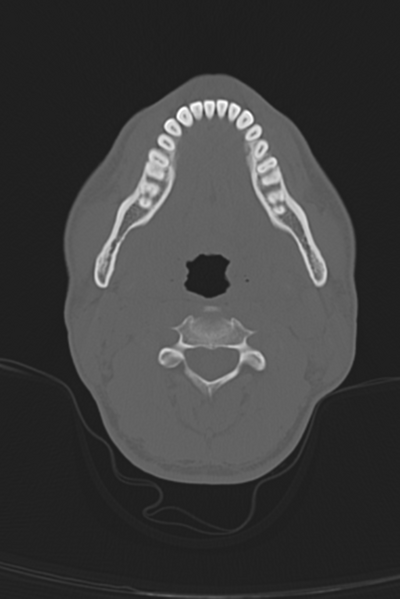 File:Anterior nasal spine fracture (Radiopaedia 46138-50494 Axial bone window 68).png