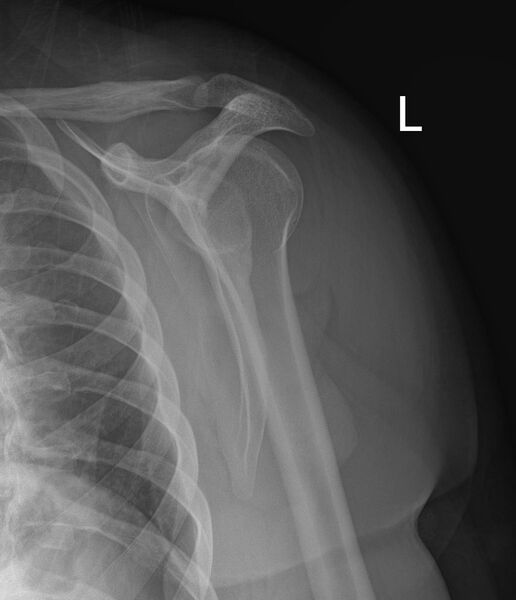File:Anterior shoulder dislocation (Radiopaedia 55849-62435 Oblique 1).jpg