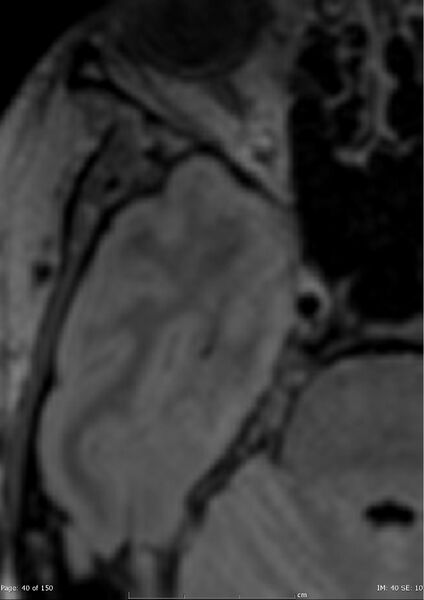 File:Anterior temporal lobe perivascular space (Radiopaedia 40946-43650 C 1).jpg