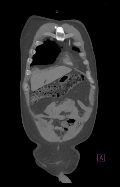 File:Aortectomy and axillary-bifemoral bypass (Radiopaedia 28303-28545 C 18).jpg
