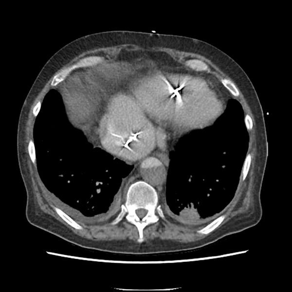 File:Aortic arch graft infection (FDG PET-CT) (Radiopaedia 71975-82437 A 48).jpg