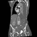 Aortic dissection (Radiopaedia 68763-78691 B 22).jpeg