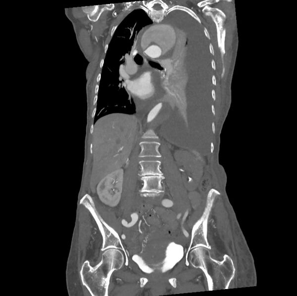 File:Aortic dissection (Radiopaedia 68763-78691 B 22).jpeg