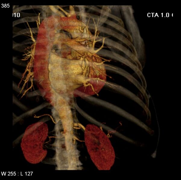 File:Aortic dissection with rupture into pericardium (Radiopaedia 12384-12647 C+ arterial phase 17).jpg
