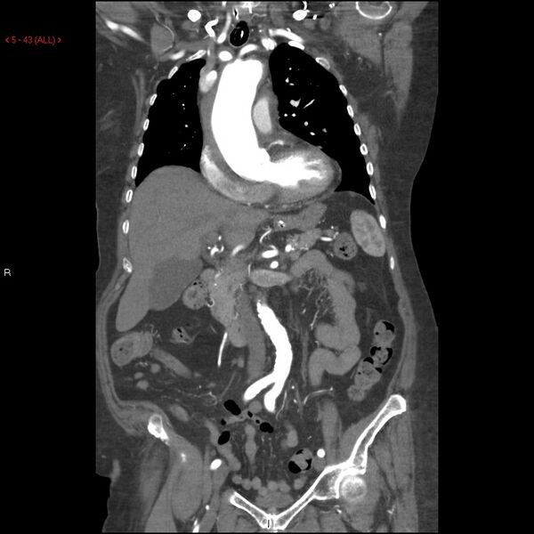 File:Aortic intramural hematoma (Radiopaedia 27746-28001 B 20).jpg