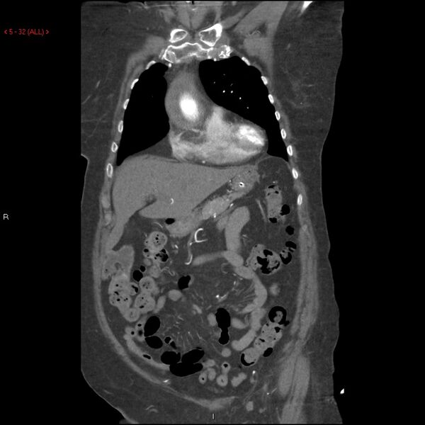 File:Aortic intramural hematoma (Radiopaedia 27746-28001 B 9).jpg