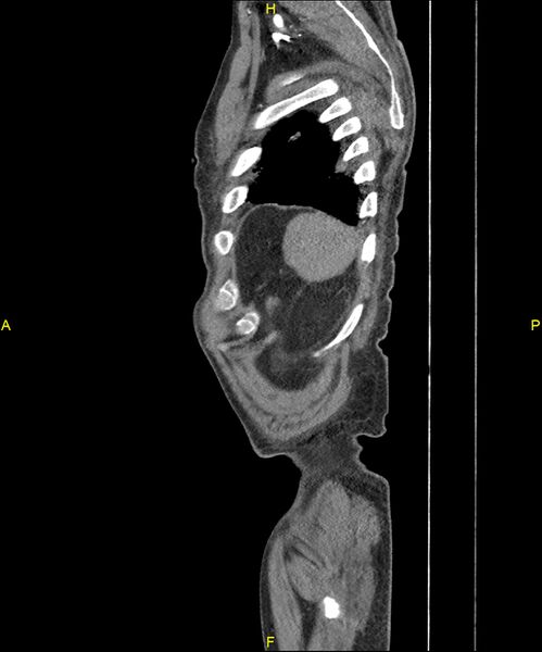 File:Aortoenteric fistula (Radiopaedia 84308-99603 C 311).jpg