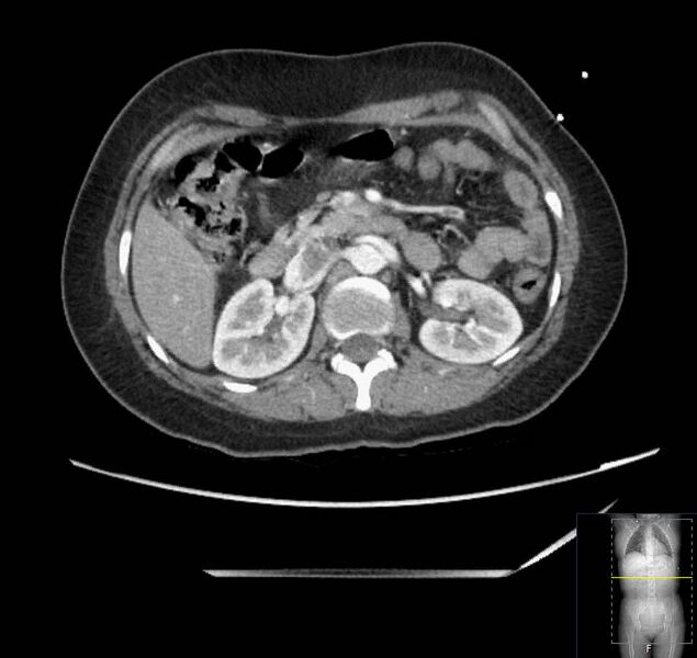 File:Appendicitis (CT angiogram) (Radiopaedia 154713-127660 Axial 121).jpg
