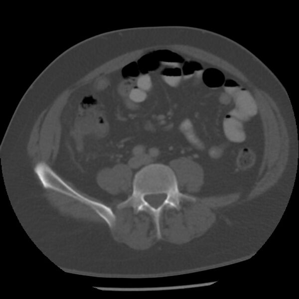 File:Appendicitis with perforation (Radiopaedia 35790-37342 Axial bone window 32).jpg