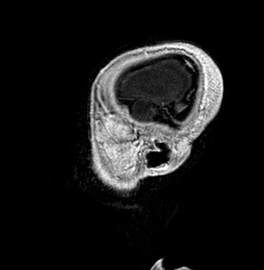 Arachnoid cyst- extremely large (Radiopaedia 68741-78451 Sagittal T1 C+ 70).jpg