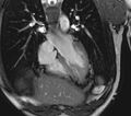 Arrhythmogenic right ventricular cardiomyopathy (Radiopaedia 39806-42237 D 125).jpg