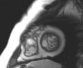 Arrhythmogenic right ventricular cardiomyopathy (Radiopaedia 69431-79307 Short axis cine 22).jpg