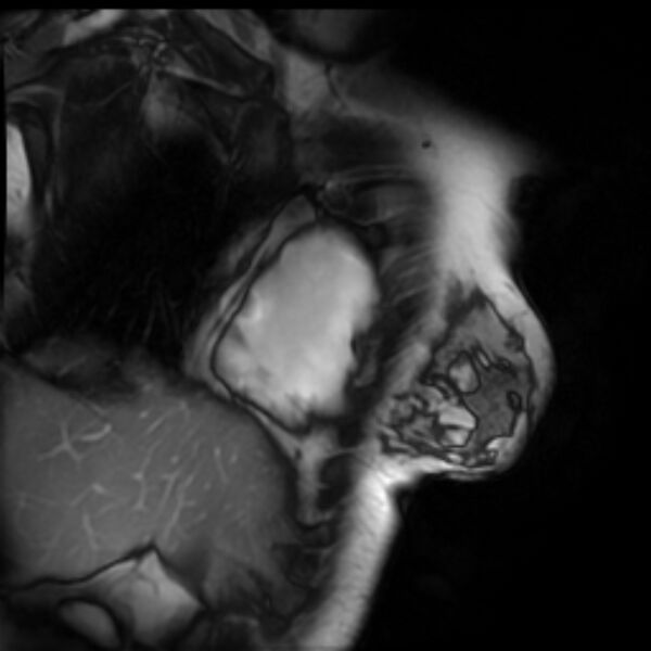 File:Arrhythmogenic right ventricular cardiomyopathy (Radiopaedia 87505-103850 2ch (RV) Cine SSFP 21).jpg