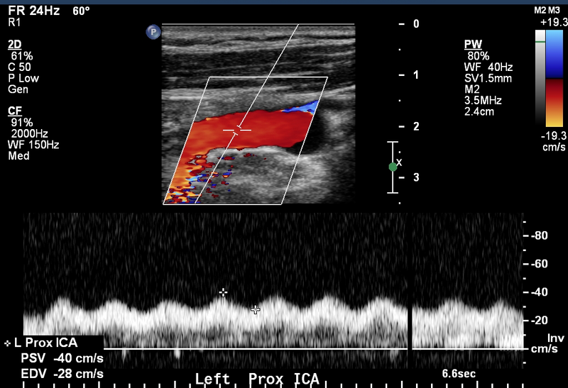 File:Arterial Doppler in left ventricular assist device patients (Radiopaedia 18113-17895 B 1).png