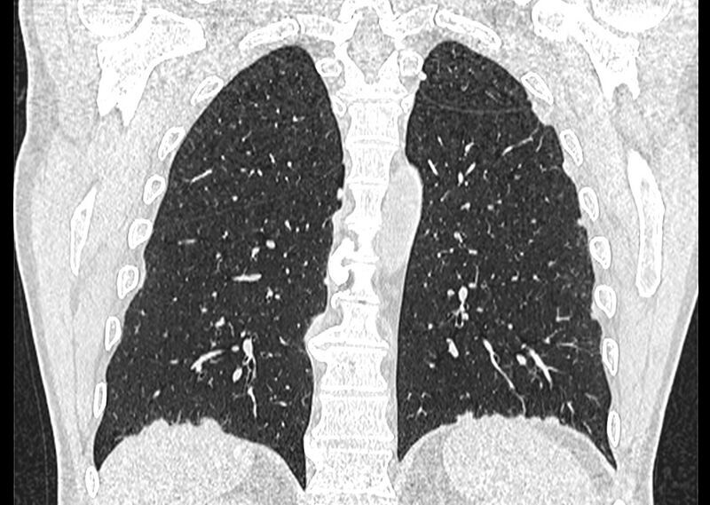 File:Asbestos pleural placques (Radiopaedia 57905-64872 Coronal lung window 214).jpg
