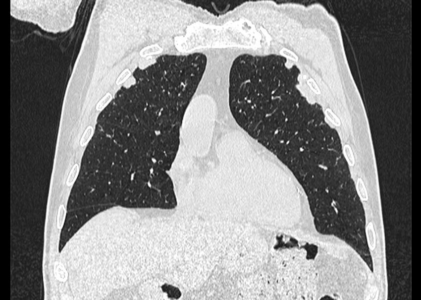 Asbestos pleural placques (Radiopaedia 57905-64872 Coronal lung window 71).jpg