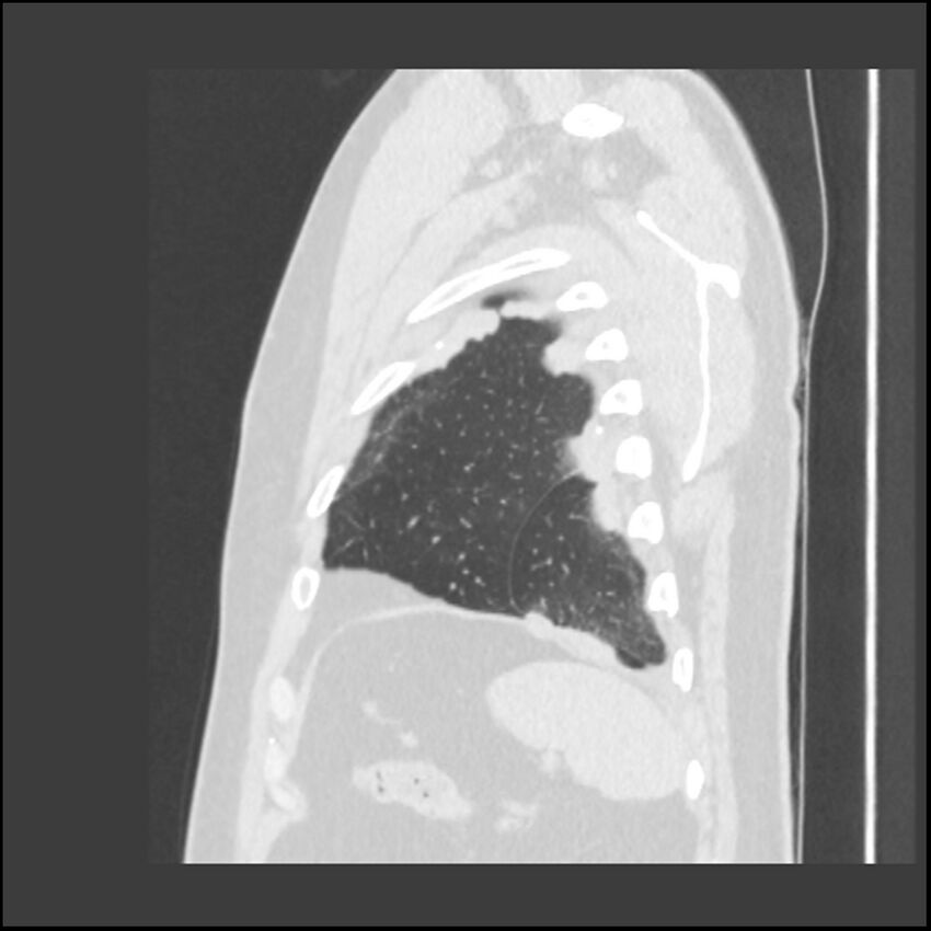 Asbestosis (Radiopaedia 45002-48961 Sagittal lung window 16).jpg