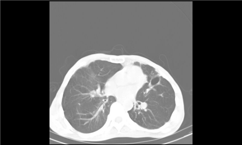 File:Aspergilloma (Radiopaedia 20788-20701 Axial lung window 19).jpg
