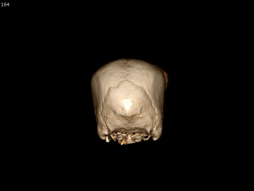 Atypical meningioma - intraosseous (Radiopaedia 64915-73867 3D volume render 164).jpg