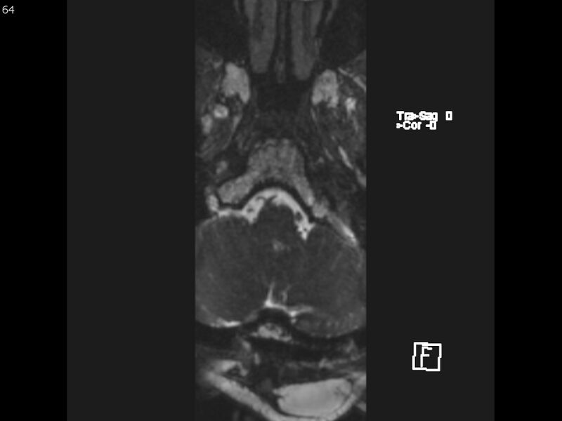 File:Atypical meningioma - intraosseous (Radiopaedia 64915-74572 Axial CISS 64).jpg