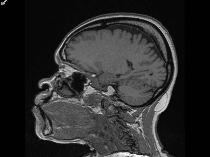 Atypical meningioma - intraosseous (Radiopaedia 64915-74572 Sagittal T1 65).jpg